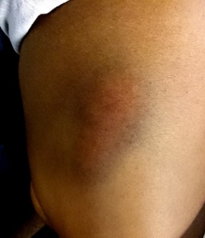 My bruised leg, the day of the fall